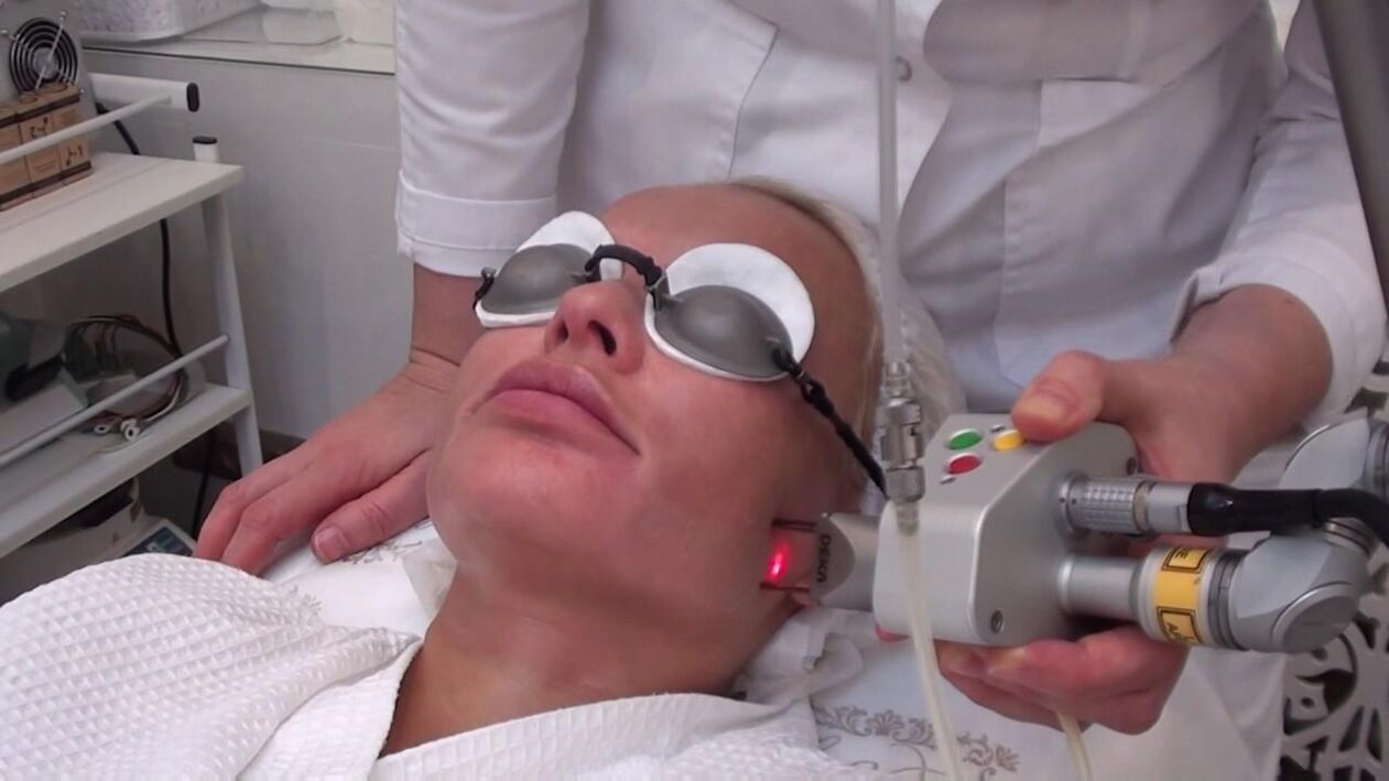 Behandeling met een laserstraal van probleemgebieden van de huid van het gezicht