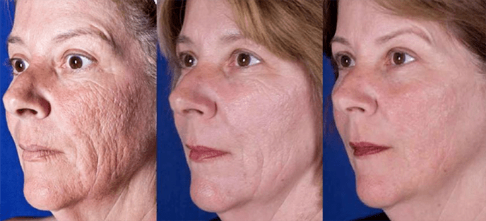 Resultaat na laserbehandeling van de gezichtshuid
