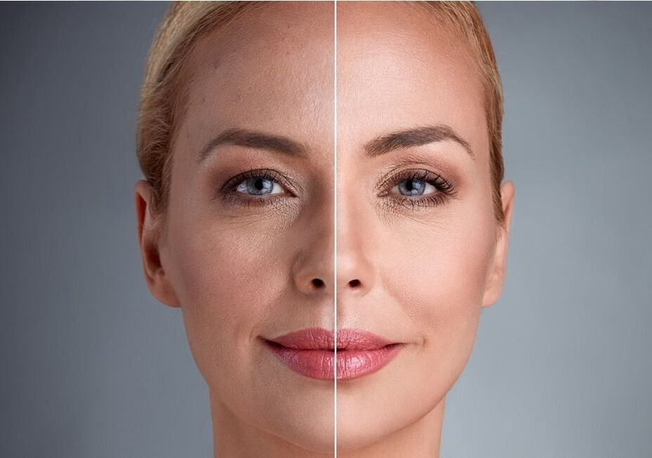 voor en na laser gezichtsverjonging