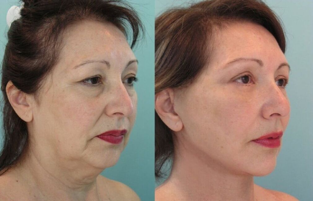 foto voor en na huidverjonging